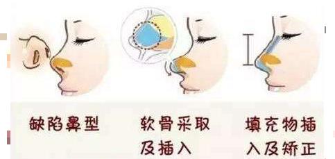 上海耳软骨垫鼻尖怎么收费？
