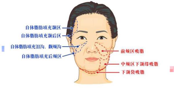 拉皮手术是什么价格