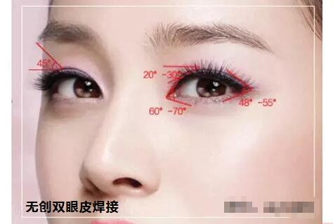 上海生物焊接双眼皮怎么收费?