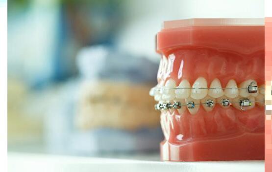 嘉兴牙齿矫正价格一般是怎么收费?