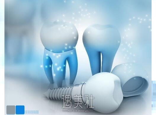 上海种植牙价格一般一颗怎么收费?是不是很贵啊?