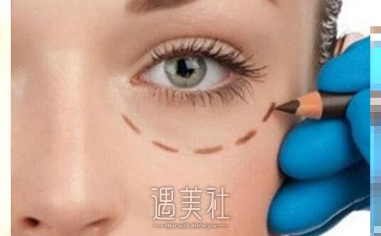 北京做埋线双眼皮手术大约怎么收费喃？比其他方式收费贵吗？