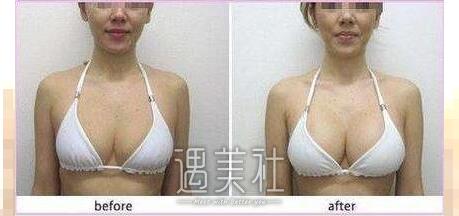 郑州自体脂肪隆胸一般需要多少钱，为什么会这么贵?