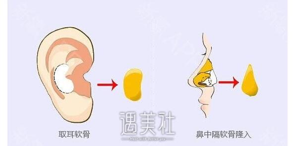 大同软骨隆鼻大概需是什么价格?什么样的价格合理?