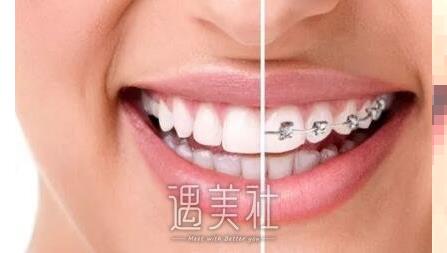 北京大学深圳医院牙齿矫正价格大概多少？贵吗？