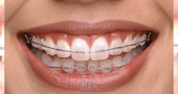 厦门牙齿矫正费用是多少?影响因素都有哪些?