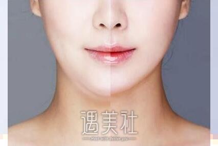 杭州做面部吸脂手术怎么收费？价格贵不贵？