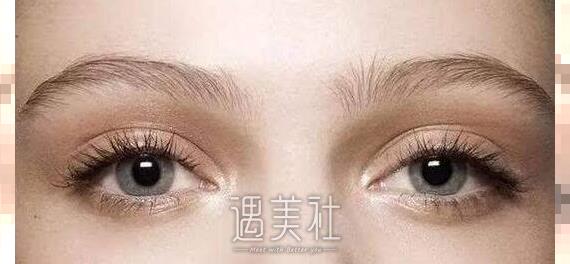 上海欧式全切双眼皮怎么收费?有哪些影响因素?