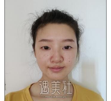 长沙湘雅三医院美容科价目表：龙剑虹全切双眼皮案例恢复过程分享~