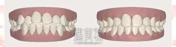 湖南省人民医院牙齿矫正费用多少?