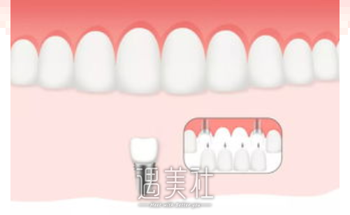 哈尔滨医科大学附属第一医院口腔医院种植牙齿怎么收费