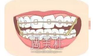 上海同济牙齿矫正费用大概多少？贵不贵？