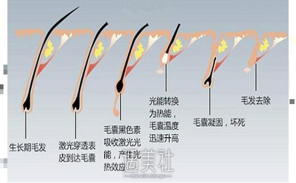 广州激光脱毛大概什么价格