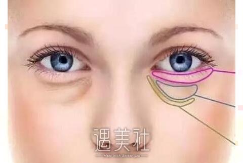 北京祛眼袋费用是多少 受哪些因素影响?