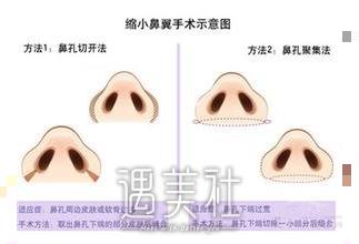 上海鼻头缩小手术是什么价格?什么影响了价格~