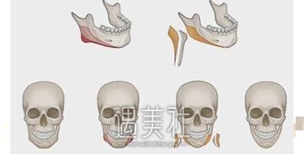 下颌角手术九院上海怎么收费?