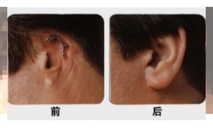 浙江耳部整形价格表 浙江绿城医院整形科耳部再造的价格贵不贵