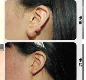 湘潭耳部整形价格表 湘潭雅美整形医院耳垂再造需要多少钱