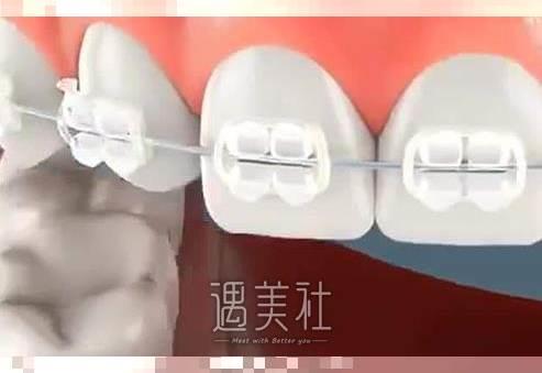 2022年哈尔滨医科大学口腔医院牙齿矫正价格揭秘：个体条件和所用材料都能影响价格