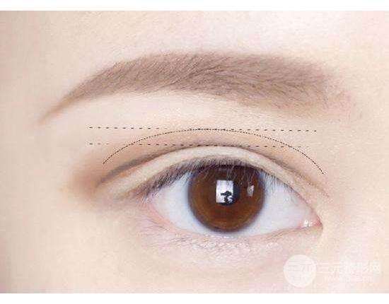 哈尔滨医大一院双眼皮手术：品质高、价格合理，让爱美之心得以实现