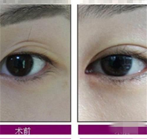 割双眼皮价格及效果分析：双眼皮手术术前术后护理完善