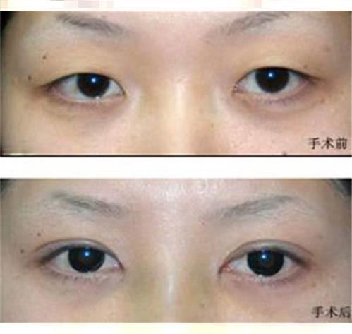 贵阳眼部综合整形：贵州眼角提升手术费用大揭秘