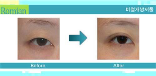 什么样的手术，做美莱韩式双眼皮价格就是这么确定的