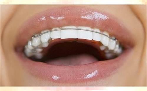 西安牙齿美容价格：种类多样,满足爱美求美者的需求